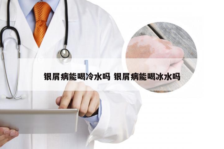 银屑病能喝冷水吗 银屑病能喝冰水吗