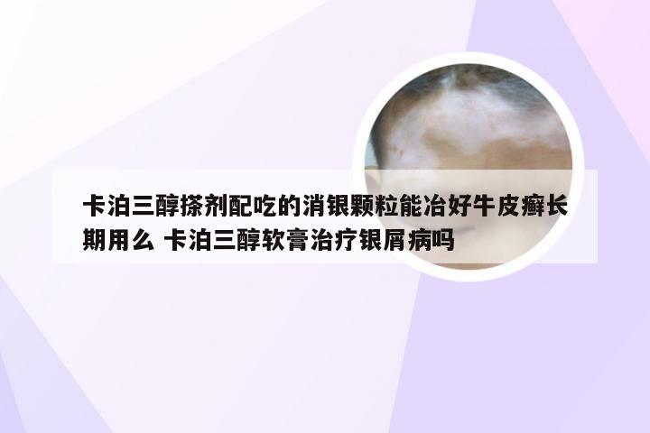 卡泊三醇搽剂配吃的消银颗粒能冶好牛皮癣长期用么 卡泊三醇软膏治疗银屑病吗