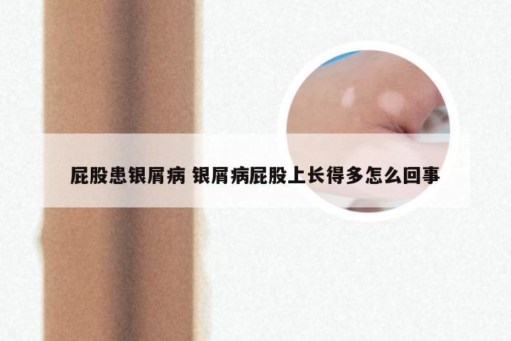 屁股患银屑病 银屑病屁股上长得多怎么回事
