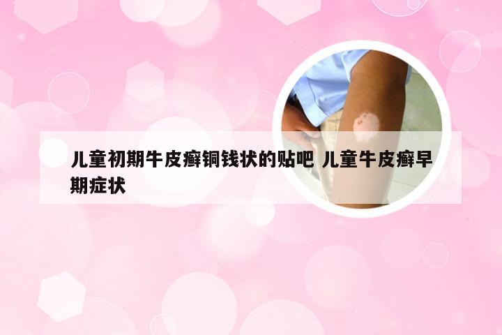 儿童初期牛皮癣铜钱状的贴吧 儿童牛皮癣早期症状