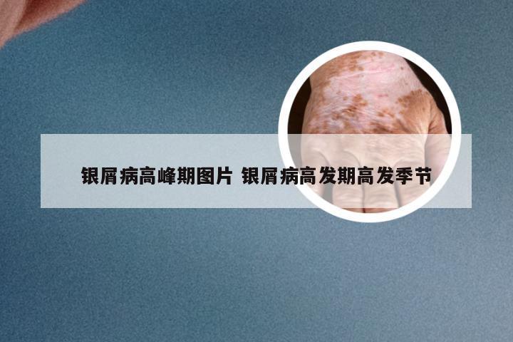 银屑病高峰期图片 银屑病高发期高发季节