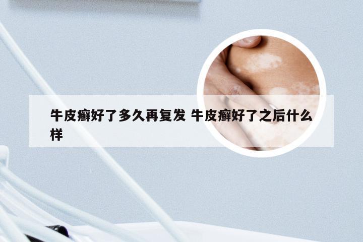 牛皮癣好了多久再复发 牛皮癣好了之后什么样