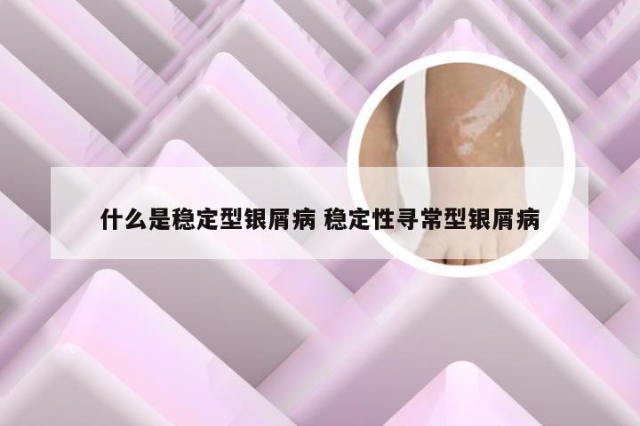 什么是稳定型银屑病 稳定性寻常型银屑病