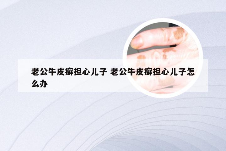 老公牛皮癣担心儿子 老公牛皮癣担心儿子怎么办