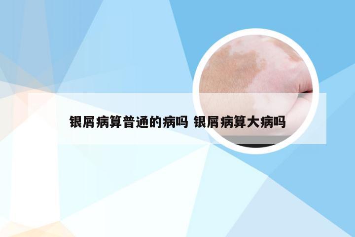 银屑病算普通的病吗 银屑病算大病吗