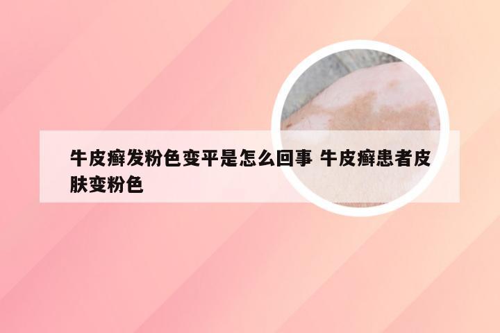 牛皮癣发粉色变平是怎么回事 牛皮癣患者皮肤变粉色