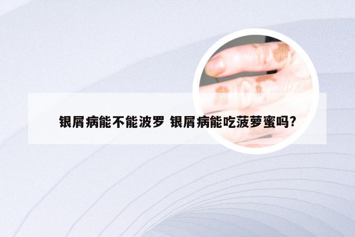 银屑病能不能波罗 银屑病能吃菠萝蜜吗?