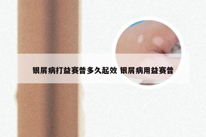 银屑病打益赛普多久起效 银屑病用益赛普