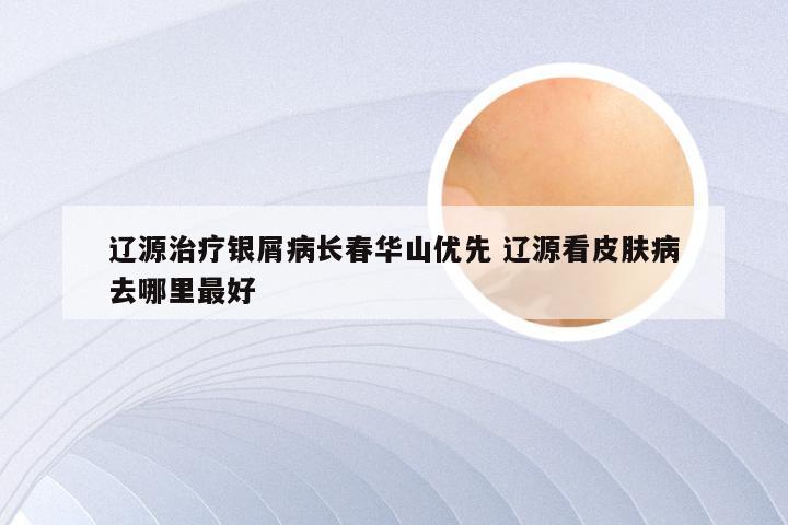 辽源治疗银屑病长春华山优先 辽源看皮肤病去哪里最好