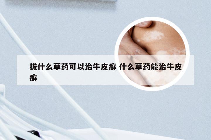 拔什么草药可以治牛皮癣 什么草药能治牛皮癣