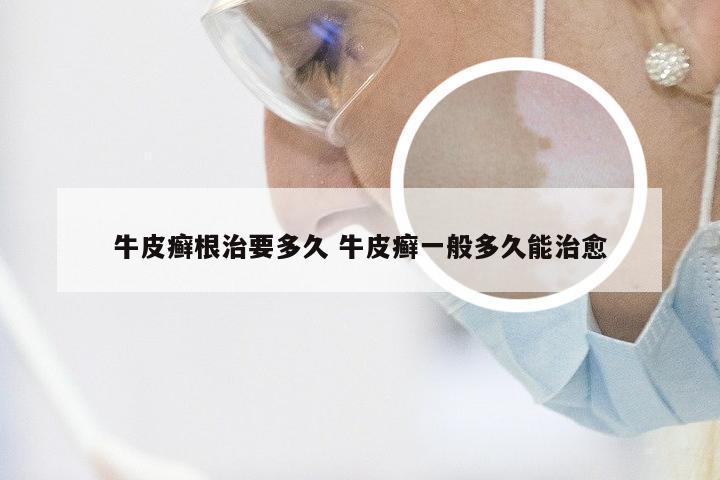 牛皮癣根治要多久 牛皮癣一般多久能治愈