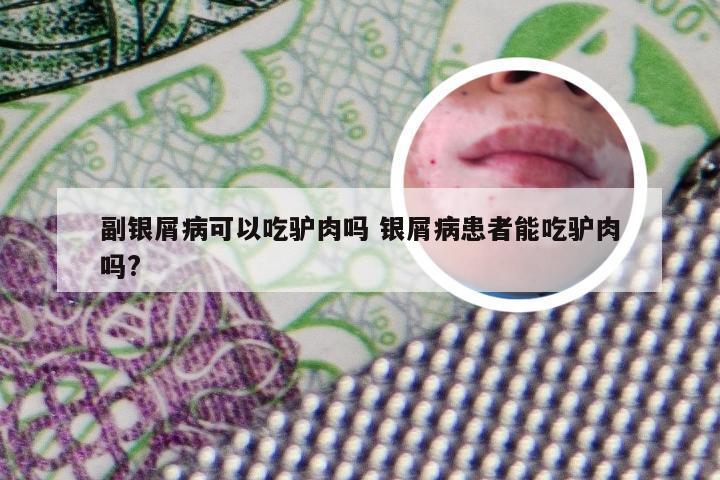 副银屑病可以吃驴肉吗 银屑病患者能吃驴肉吗?