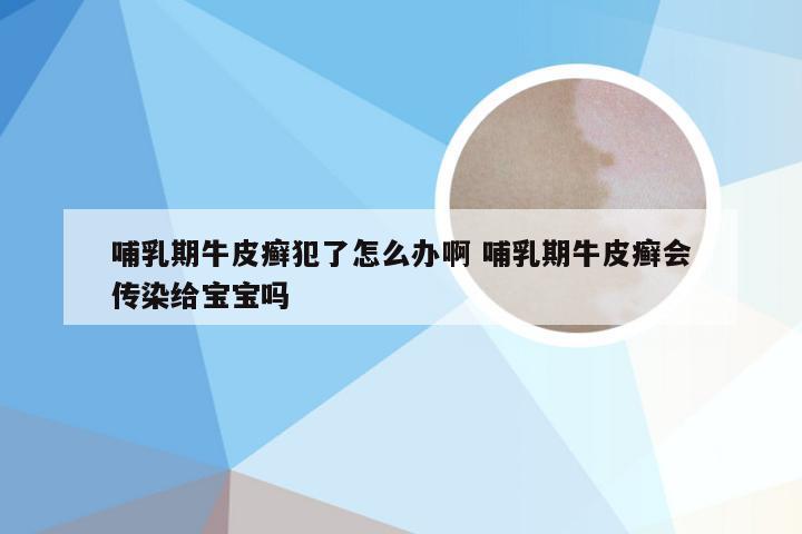 哺乳期牛皮癣犯了怎么办啊 哺乳期牛皮癣会传染给宝宝吗