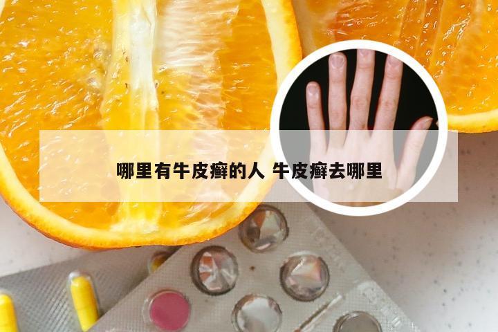 哪里有牛皮癣的人 牛皮癣去哪里