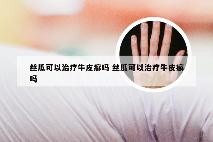 丝瓜可以治疗牛皮癣吗 丝瓜可以治疗牛皮癣吗