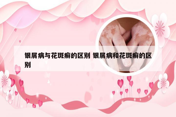 银屑病与花斑癣的区别 银屑病和花斑癣的区别