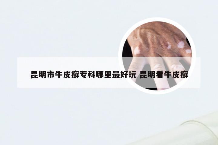 昆明市牛皮癣专科哪里最好玩 昆明看牛皮癣