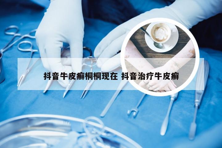 抖音牛皮癣桐桐现在 抖音治疗牛皮癣