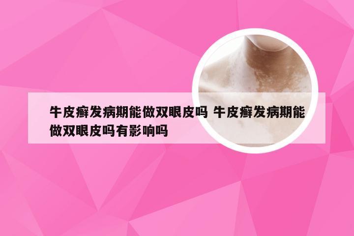 牛皮癣发病期能做双眼皮吗 牛皮癣发病期能做双眼皮吗有影响吗