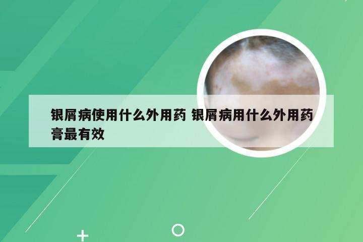 银屑病使用什么外用药 银屑病用什么外用药膏最有效