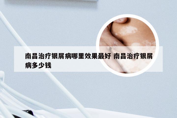 南昌治疗银屑病哪里效果最好 南昌治疗银屑病多少钱