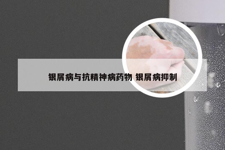 银屑病与抗精神病药物 银屑病抑制
