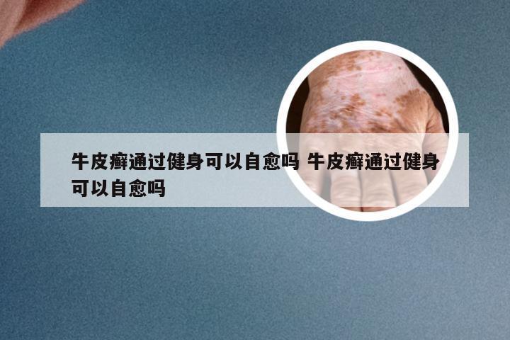 牛皮癣通过健身可以自愈吗 牛皮癣通过健身可以自愈吗