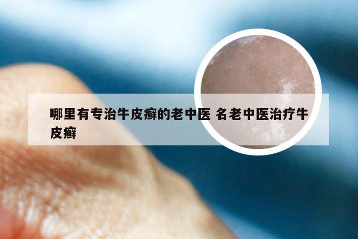 哪里有专治牛皮癣的老中医 名老中医治疗牛皮癣