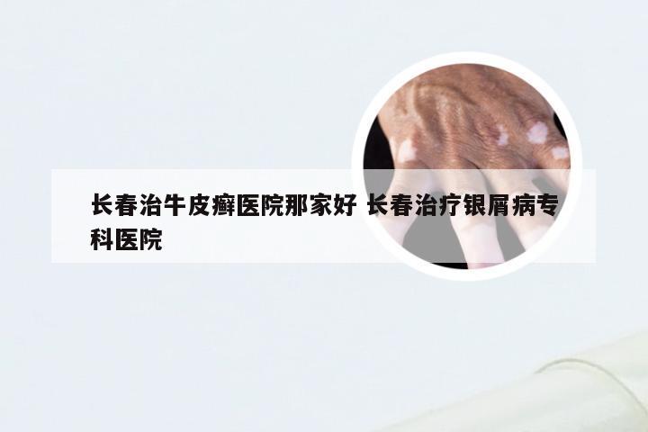 长春治牛皮癣医院那家好 长春治疗银屑病专科医院