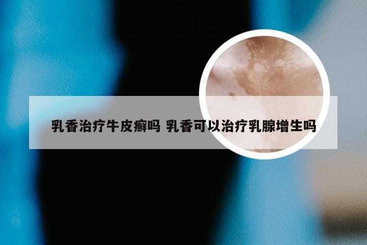 乳香治疗牛皮癣吗 乳香可以治疗乳腺增生吗