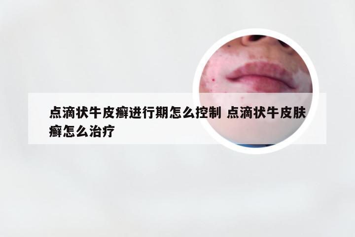 点滴状牛皮癣进行期怎么控制 点滴状牛皮肤癣怎么治疗
