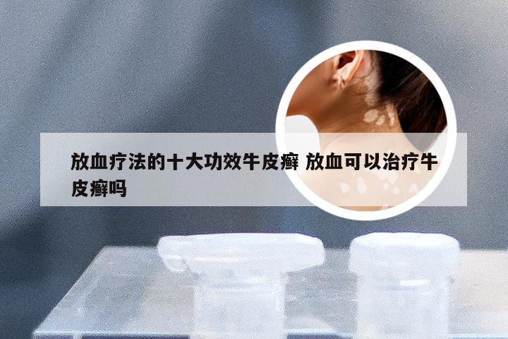 放血疗法的十大功效牛皮癣 放血可以治疗牛皮癣吗