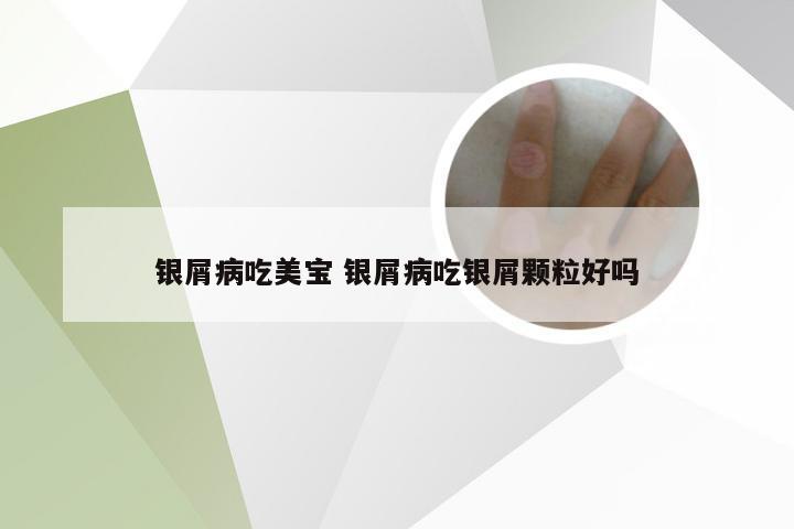 银屑病吃美宝 银屑病吃银屑颗粒好吗