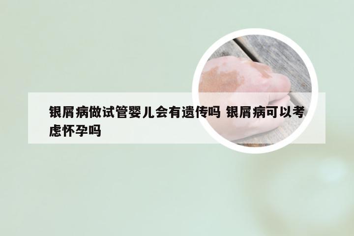 银屑病做试管婴儿会有遗传吗 银屑病可以考虑怀孕吗