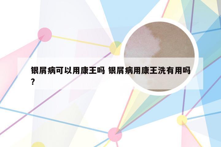 银屑病可以用康王吗 银屑病用康王洗有用吗?