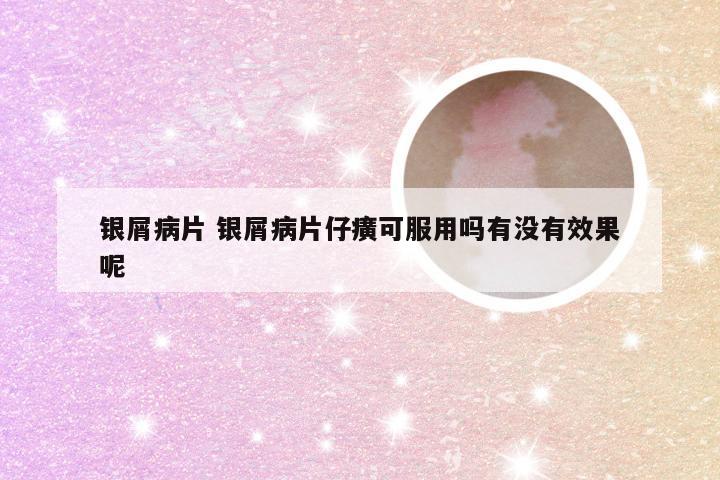 银屑病片 银屑病片仔癀可服用吗有没有效果呢