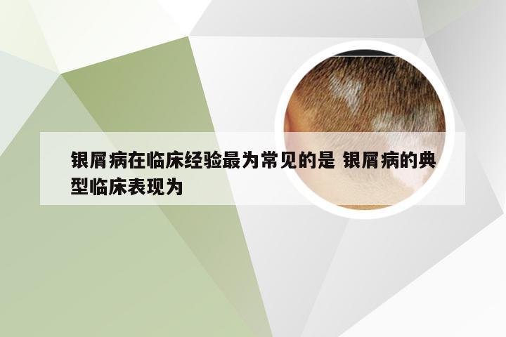 银屑病在临床经验最为常见的是 银屑病的典型临床表现为