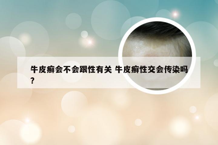 牛皮癣会不会跟性有关 牛皮癣性交会传染吗?