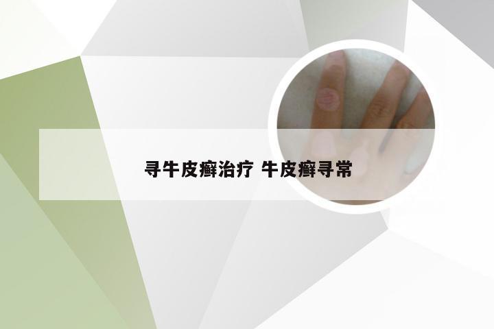 寻牛皮癣治疗 牛皮癣寻常
