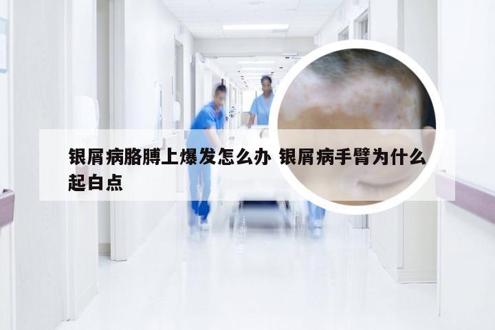 银屑病胳膊上爆发怎么办 银屑病手臂为什么起白点
