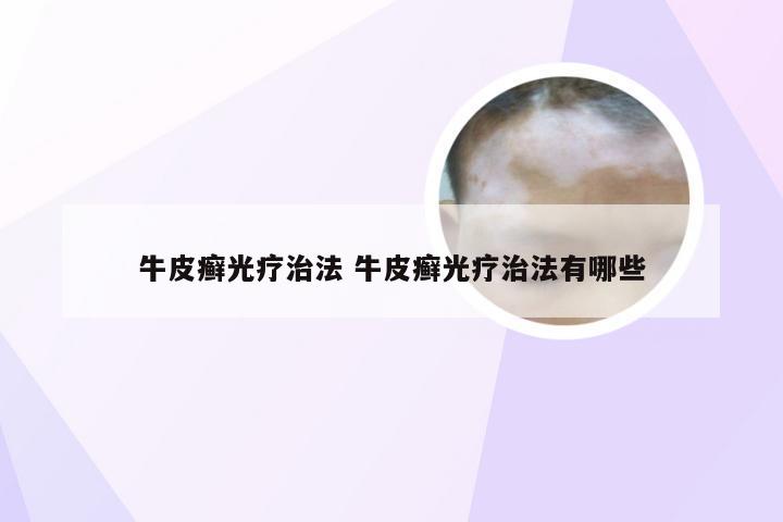牛皮癣光疗治法 牛皮癣光疗治法有哪些