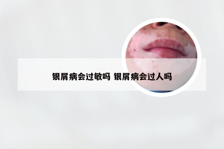 银屑病会过敏吗 银屑病会过人吗