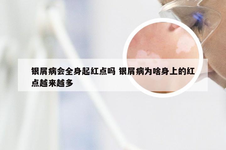 银屑病会全身起红点吗 银屑病为啥身上的红点越来越多
