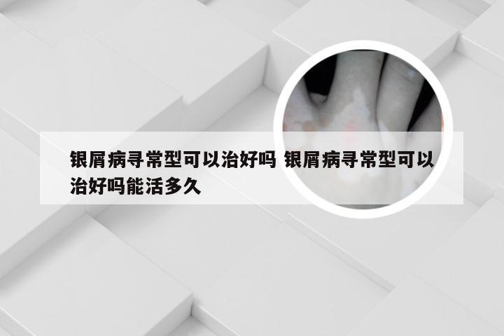 银屑病寻常型可以治好吗 银屑病寻常型可以治好吗能活多久