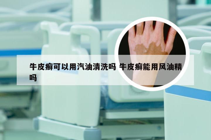 牛皮癣可以用汽油清洗吗 牛皮癣能用风油精吗
