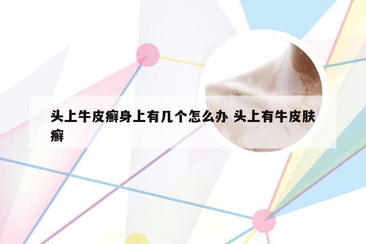 头上牛皮癣身上有几个怎么办 头上有牛皮肤癣