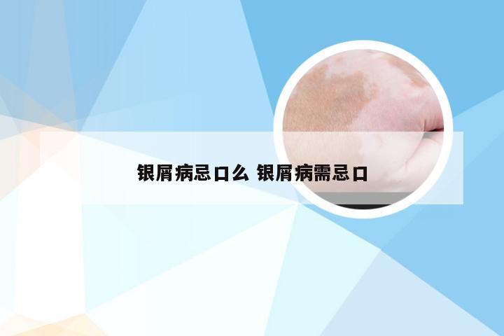 银屑病忌口么 银屑病需忌口