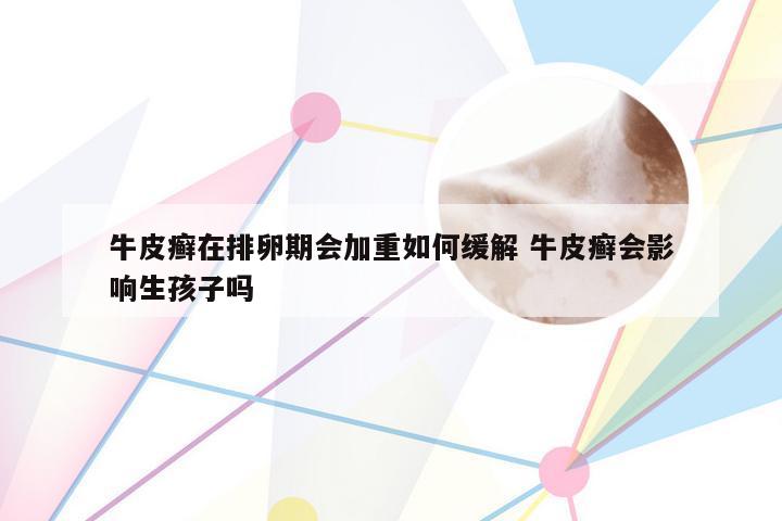 牛皮癣在排卵期会加重如何缓解 牛皮癣会影响生孩子吗