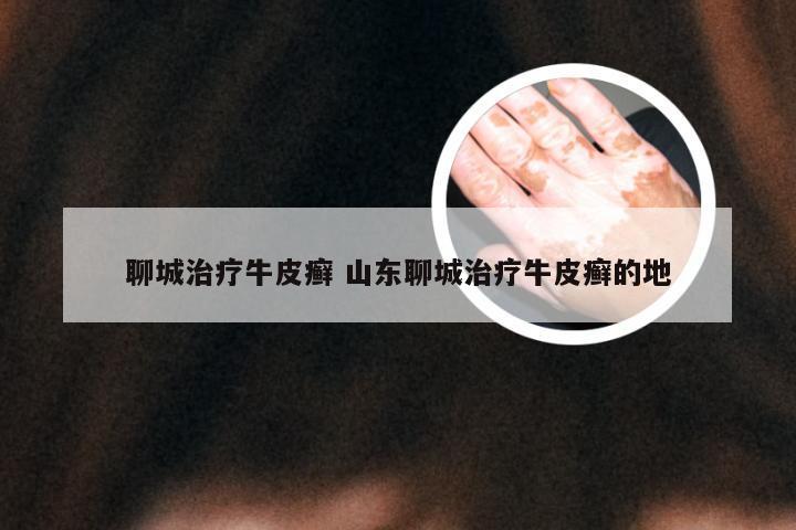 聊城治疗牛皮癣 山东聊城治疗牛皮癣的地