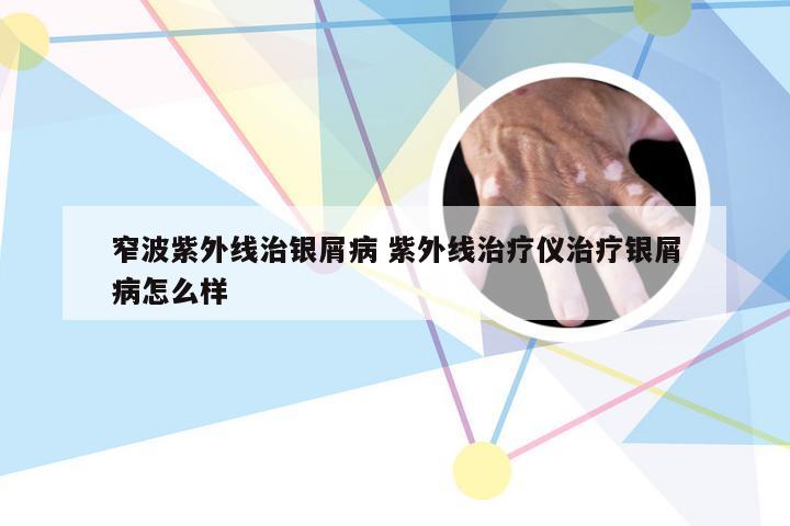 窄波紫外线治银屑病 紫外线治疗仪治疗银屑病怎么样